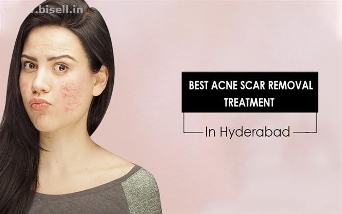 Acne scar removal treatment