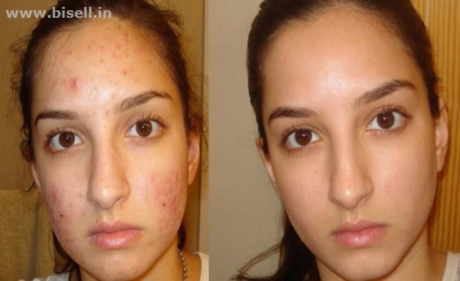 Acne Scars Laser Treatment in Delhi