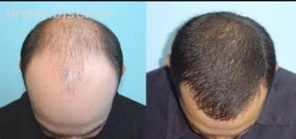 baldness treatment in Kolkata, male baldness treatment in Kolkata, female baldness treatment in Kolkata