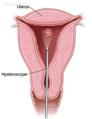 Best Hysteroscopy Centre in Jaipur