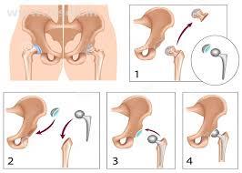 Best Orthopedic for all kind of Joint Replacement