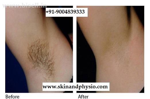 BEST TREATMENT FOR LASER HAIR REMOVAL