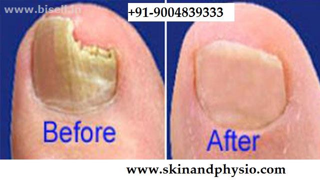 BEST TREATMENT FOR NAIL INFECTION