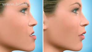 Chin Correction Surgery In Lucknow