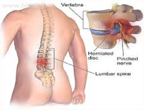 Decompression Treatment for Spinal Fusion in Delhi