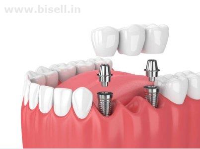 Dental implant cost in chennai - Akeela Dental Care