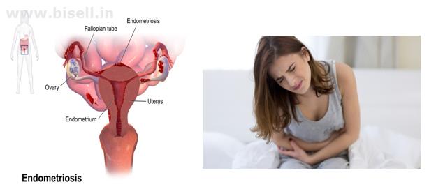 Endometriosis Treatment in Bangalore