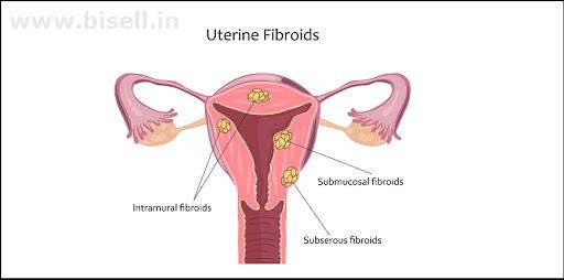 Fibroid Uterus