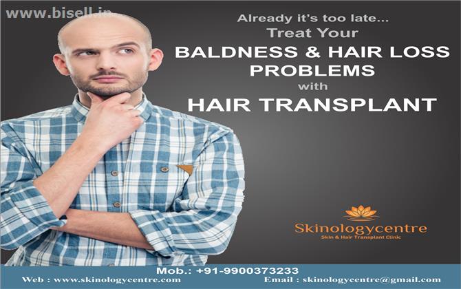 FUE Hair Transplant | FUE Hair Transplant Cost in Bangalore 2019- Low Cost Hair Transplant