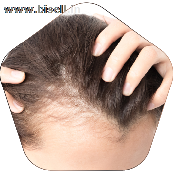 Hair loss treatment in Hyderabad.