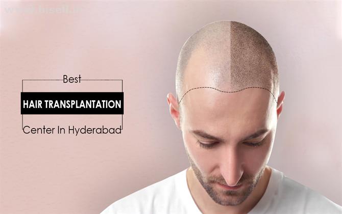 Hair transplantation center in hyderabad.