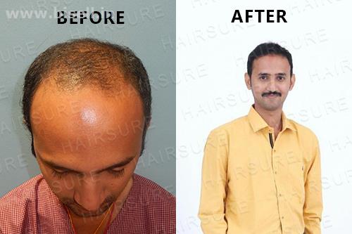 HairSure: Best Hair Transplant Clinic in Hyderabad