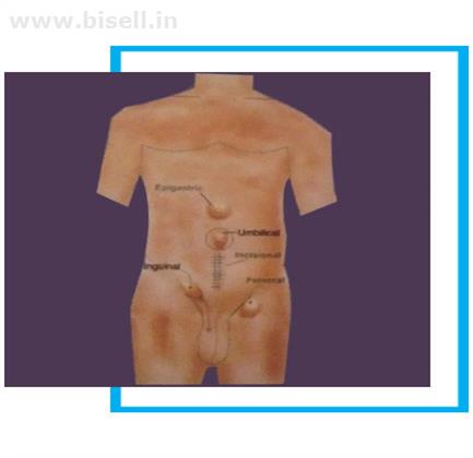 Hernia Surgery Procedure & Repair- Inguinal Hernia Surgery