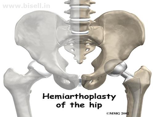 Hip Joint replaced with artificial Components