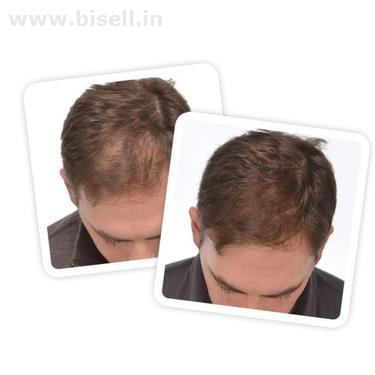 iGrow-A Safe And Effective System Designed For Hair Loss Control