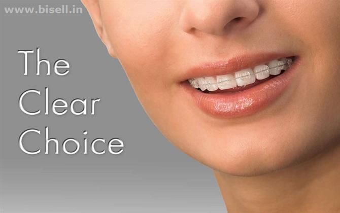 Invisalign Clinic in Gurgaon