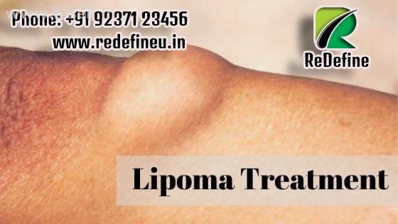 Lipoma Removal in Hyderabad | Lipoma Removal Cost