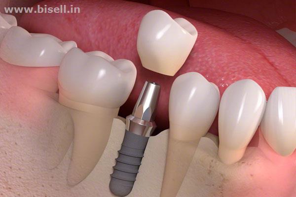 Opt for Root Canal Treatment in Delhi for a Healthy Mouth That is Pain and Trouble Free