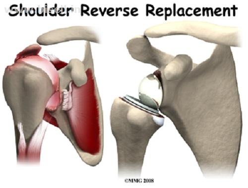 Reverse Shoulder Joint Replacement Surgery