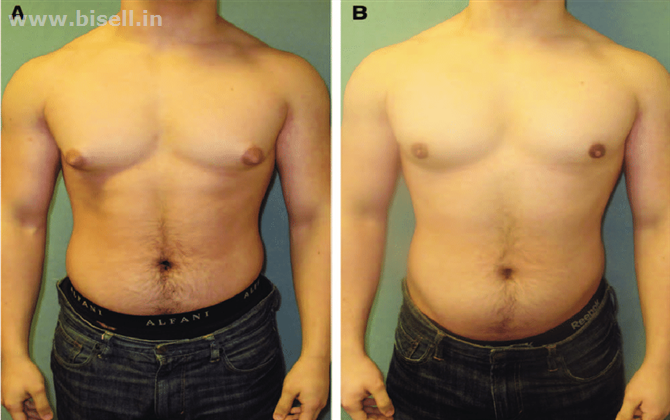 Top 10 Male Breast Surgery In Lucknow